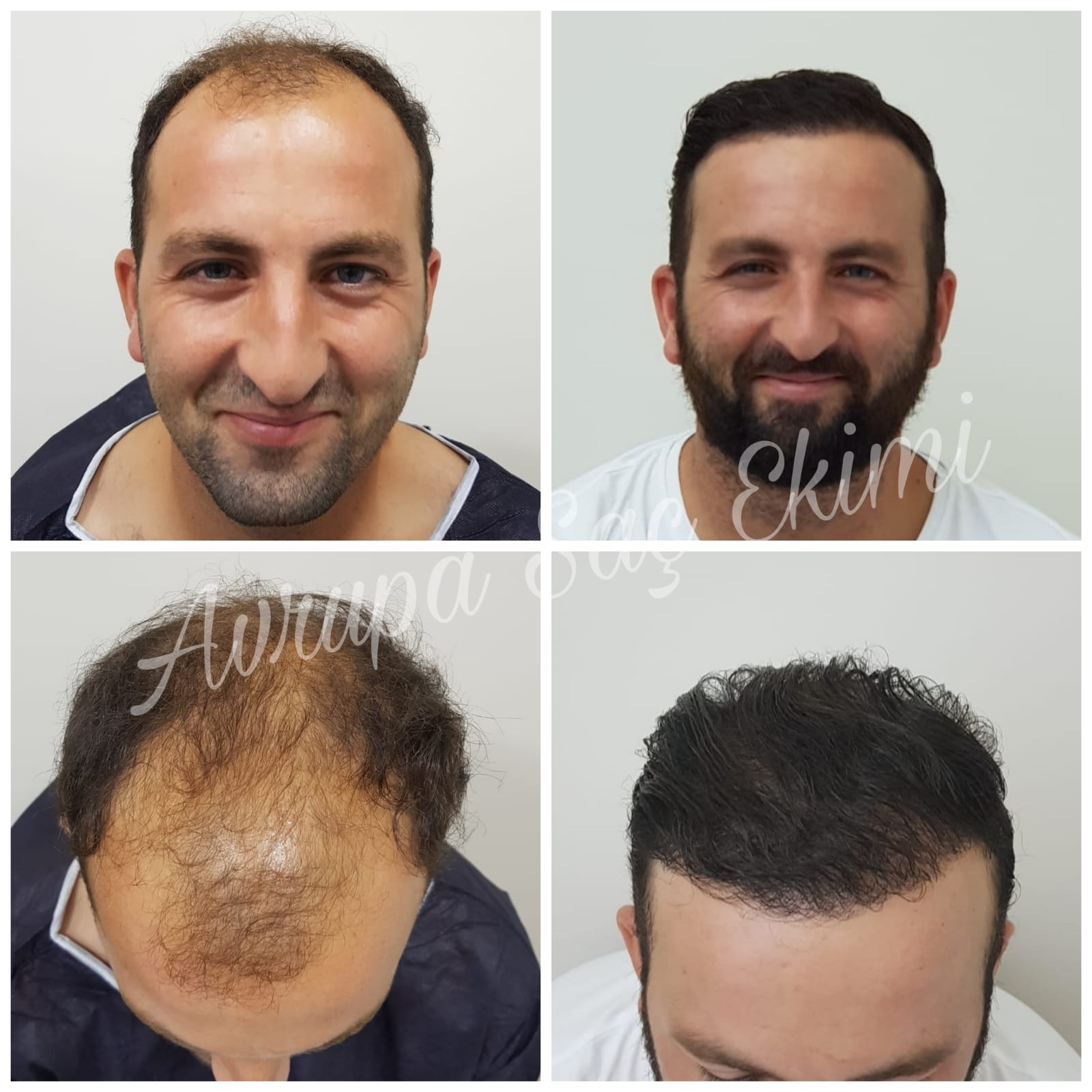 rhinoplasty expert nyc
