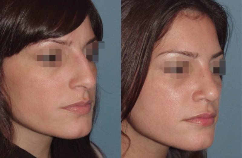 rhinoplasty expert nyc