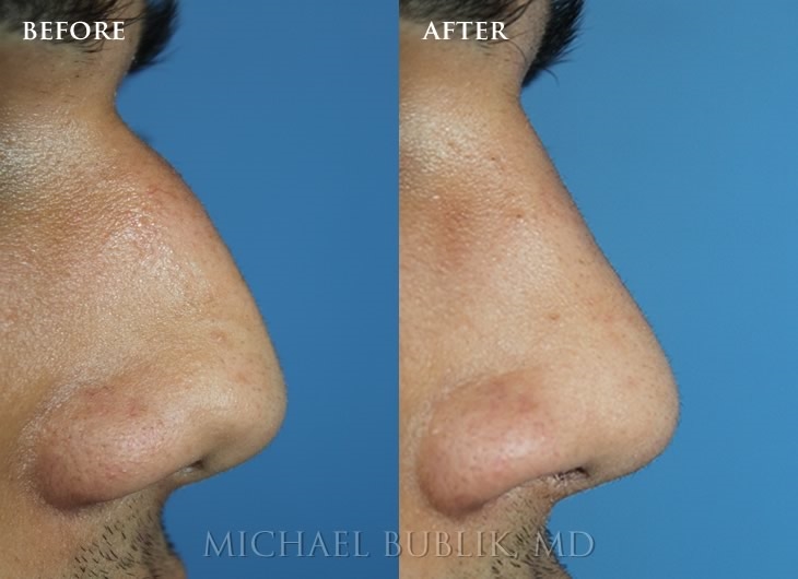 rhinoplasty expert nyc